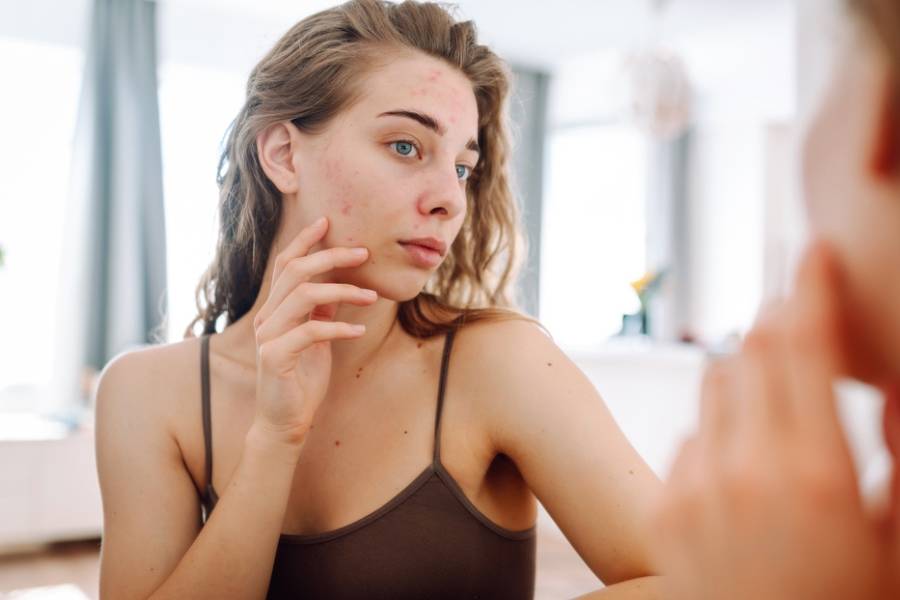 Acne Discrimination: Breaking Stigmas and Promoting Inclusivity in Beauty Standards