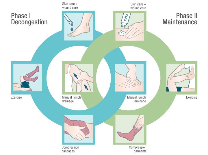 lymphedema therapy — National Lymphedema Network