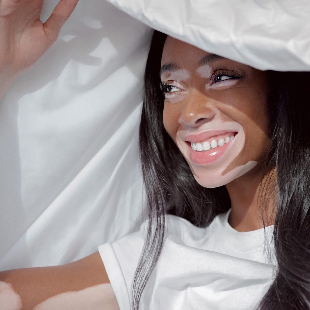 Winnie-Harlow-breaks-beauty-standards