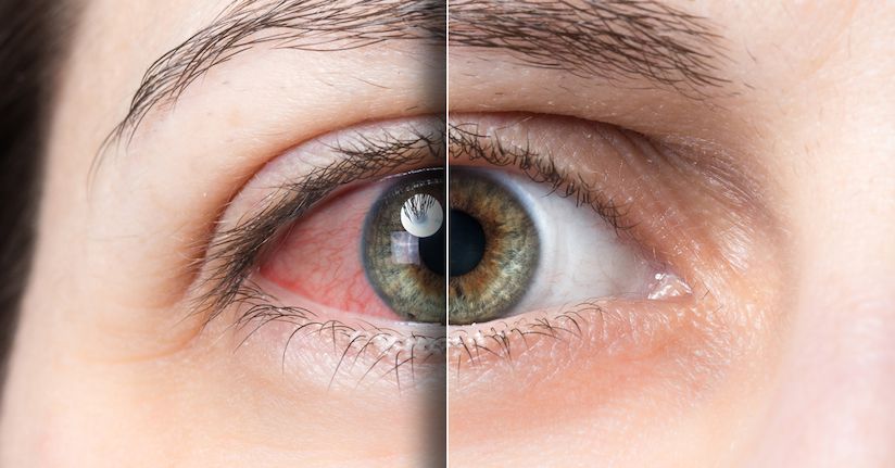 Dry Eye: A Leading Cause of Light Sensitivity - TheraSpecs